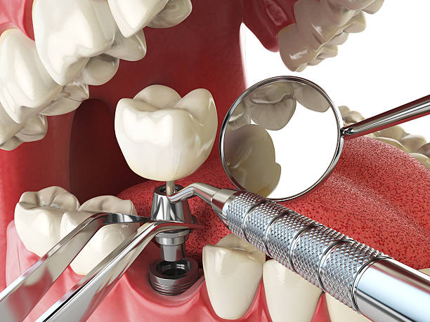 Best Emergency Dentist for Lost Fillings or Crowns in Winchester, CA